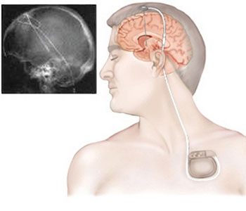 functional Neuro Consultant